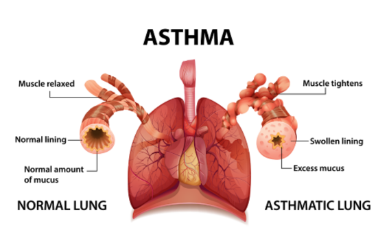 An illustration showing a normal and an asthmatic lung