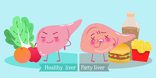 Comparison between a healthy liver and a fatty liver
